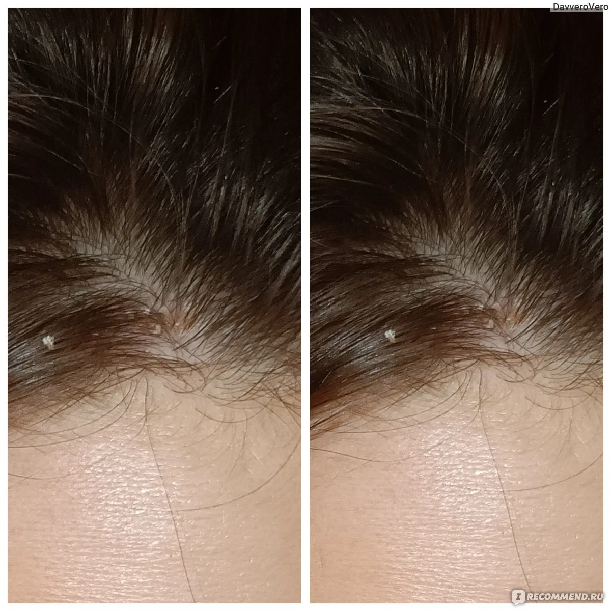 Визуальное объяснение: что делать если чешется голова