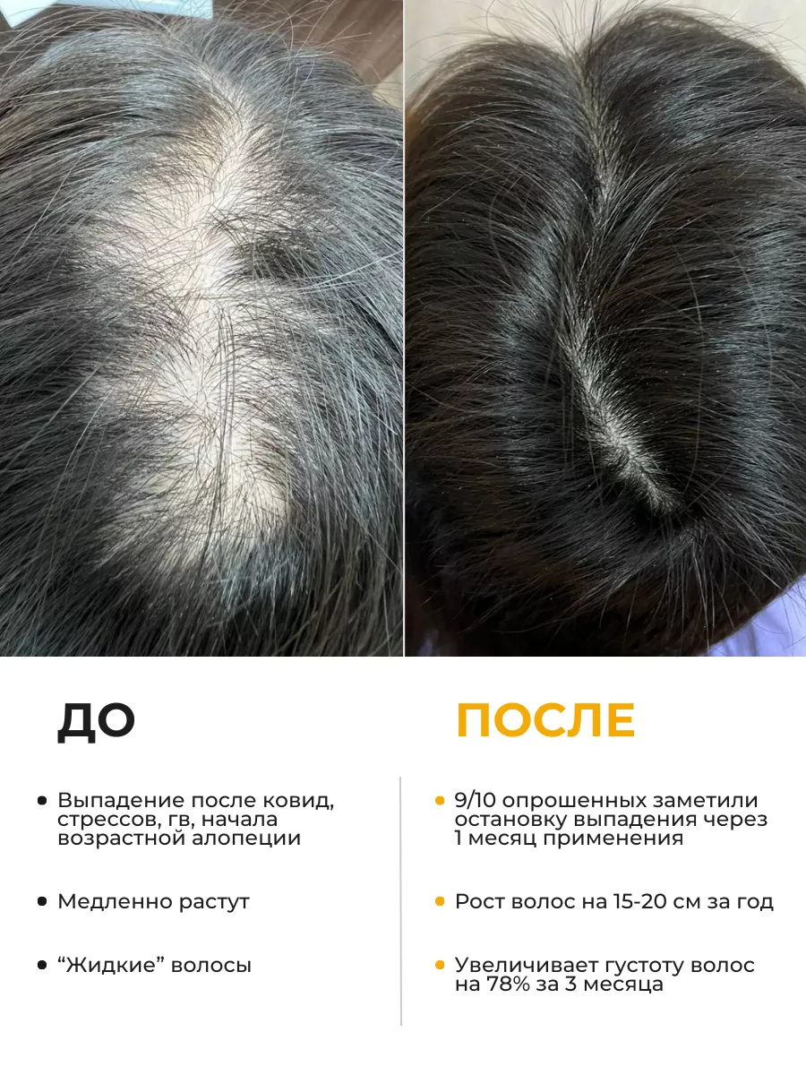 Визуальное объяснение: что делать при выпадении волос