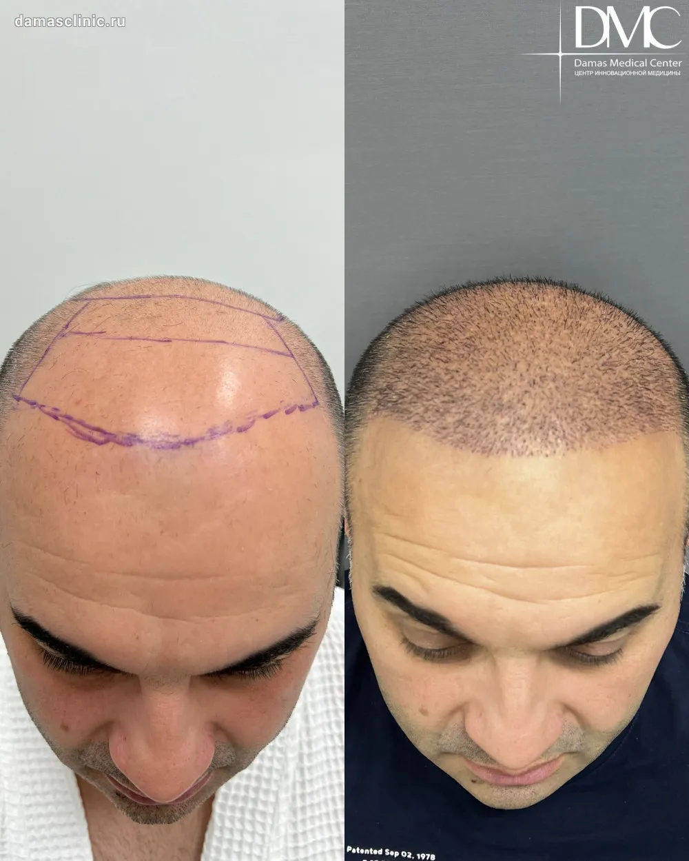 Сравнительный анализ: пересадка волос мужчинам