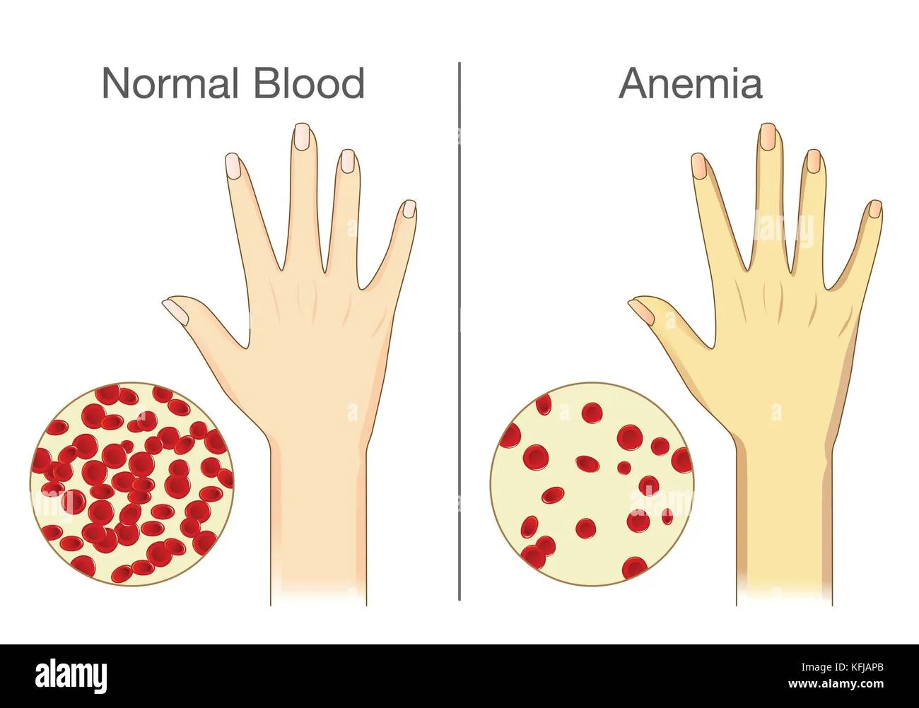 Визуальное руководство по: признаки низкого железа