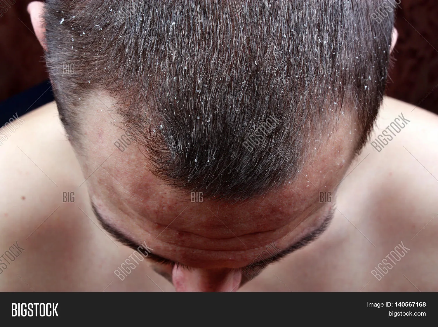 Визуальное объяснение: себорейный дерматит кожи головы