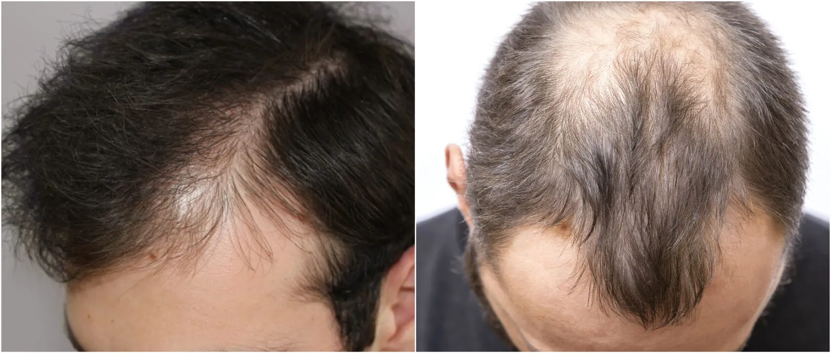 Актуальные новости: телогеновое выпадение волос