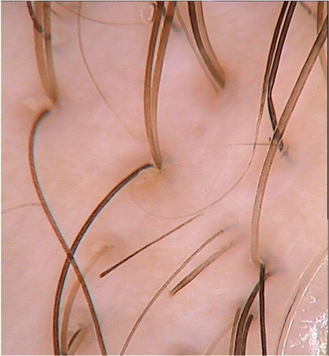 Образовательный материал - Диагностика выпадения волос: причины, методы и самостоятельная проверка Визуальное объяснение: трихоскопия