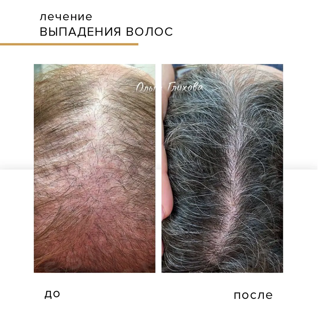 Визуальное объяснение: выпадение волос лечение отзывы